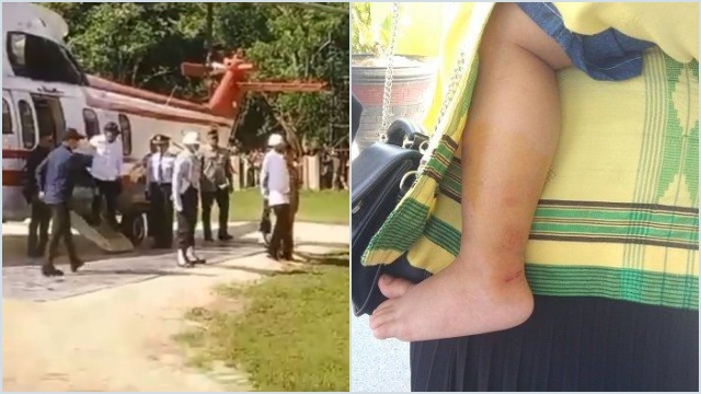 Kondisi Anak 3 Tahun Tertimpa Dahan Pohon saat Helikopter Jokowi Mendarat di Muna Sulawesi Tenggara